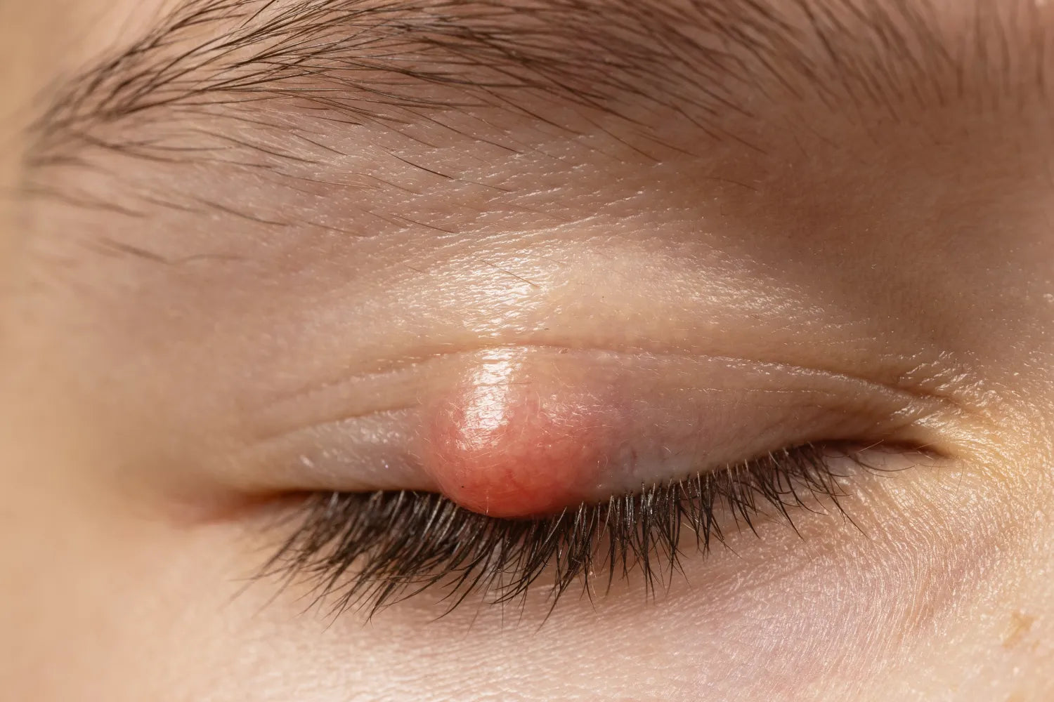 Are Styes Contagious? Everything To Know