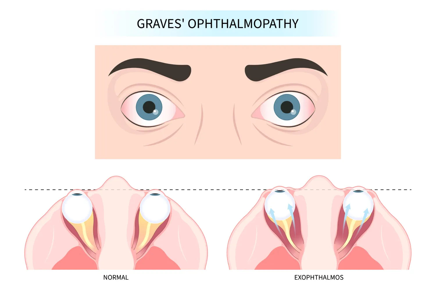 What Is Thyroid Eye Disease? Causes, Symptoms, and Treatment