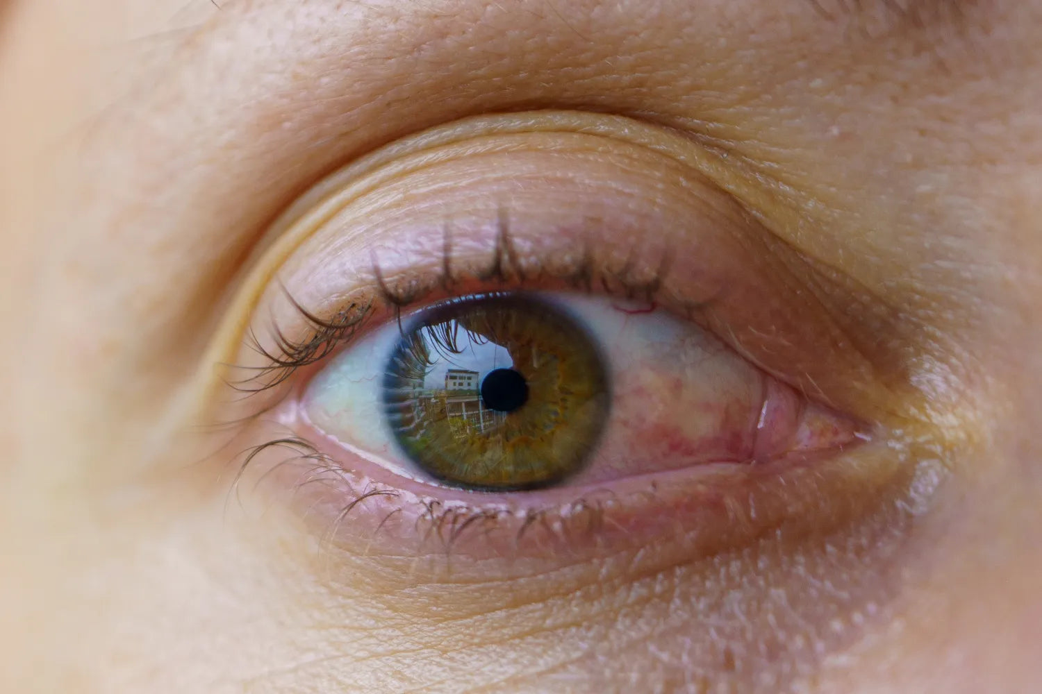 Is Your Eye Pain the Result of a Stye? Here's How To Tell