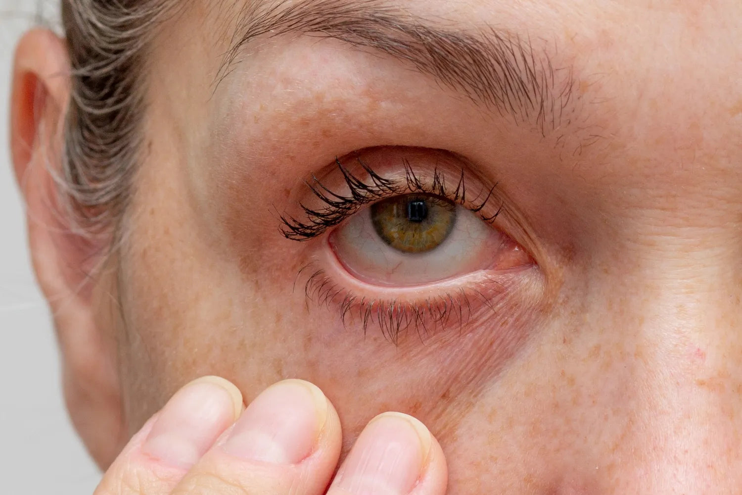Why Uveitis, an Inflammatory Eye Disease, Is Serious