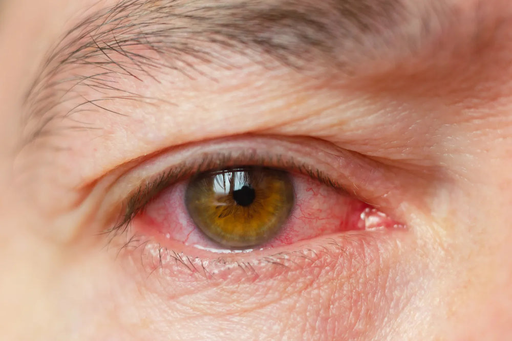Are You at Risk? Conjunctivitis and Its Causes
