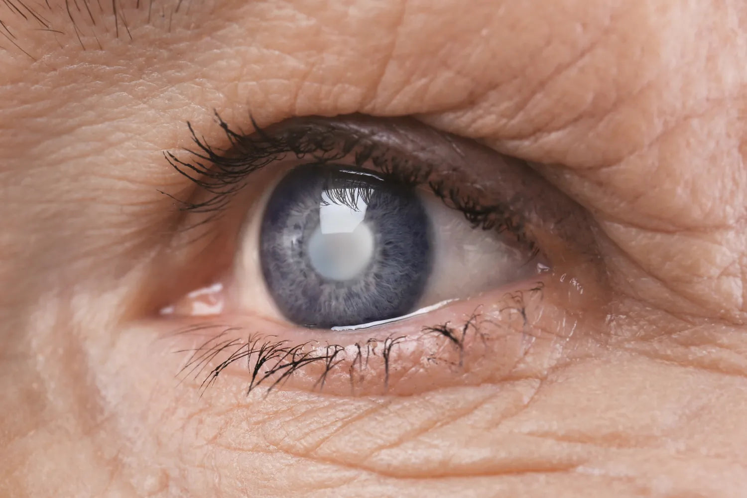 Guide To Understanding the Different Types of Cataracts